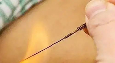 针灸治疗中风之后手功能障碍