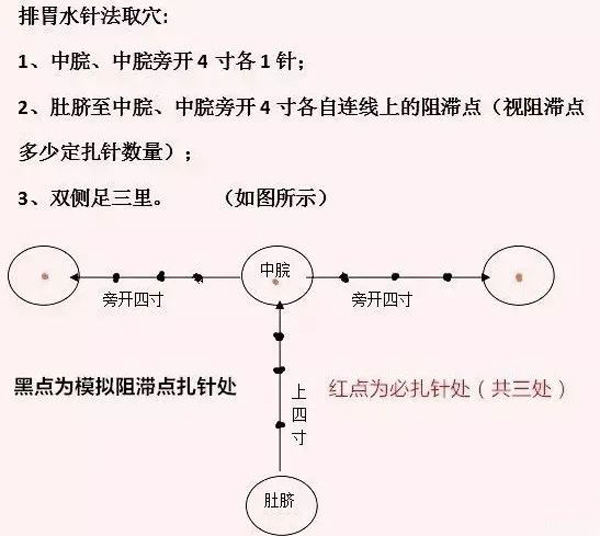 奇门排痰针法