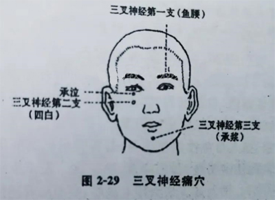 一针疗法：三叉神经痛