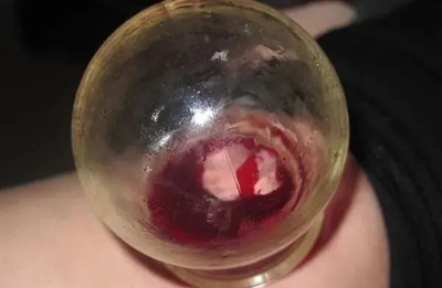 委中一穴能调多种病症
