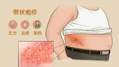 带状疱疹