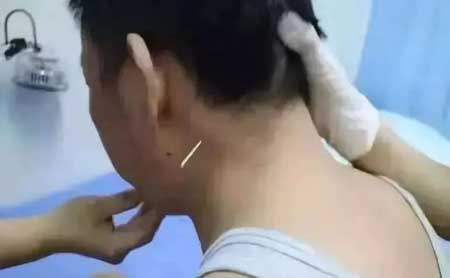 “面三针”治疗面瘫