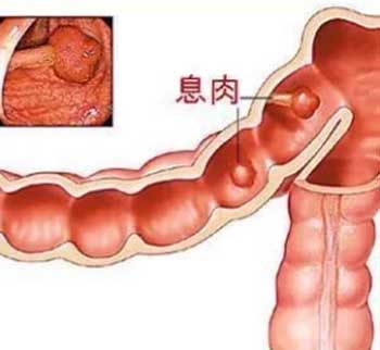 治疗息肉验方