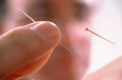 急性腰扭伤一针疗法