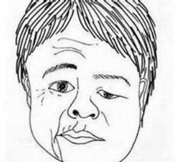 正颜汤，善治中风口眼歪斜