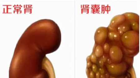 越鞠丸，消散各种结节的特效方