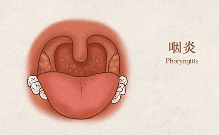 慢性咽炎折磨人，如何浇灭喉咙里的那把“虚火”？