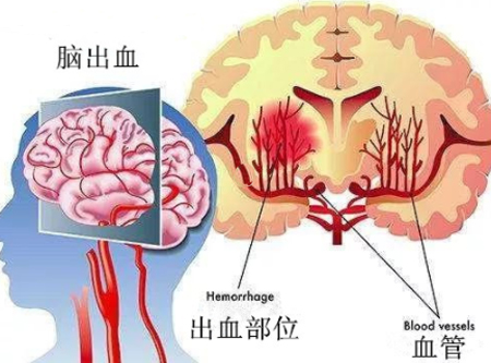 名中医辨治脑出血
