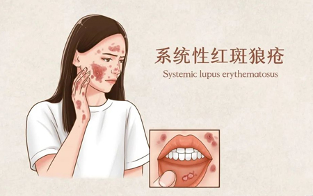 中医治红斑狼疮验案