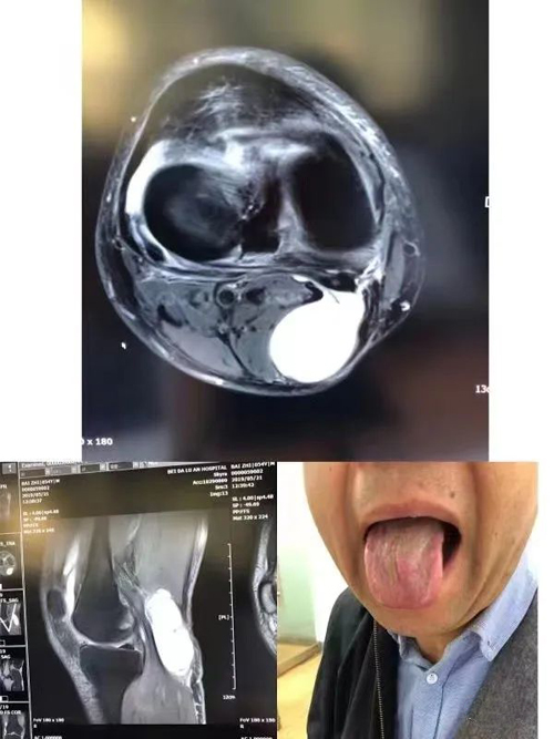 腘窝囊肿医案