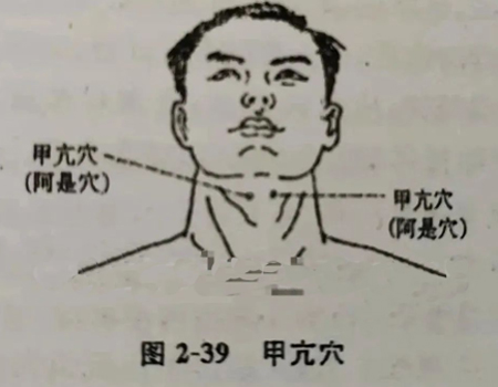 一针疗法：甲亢穴