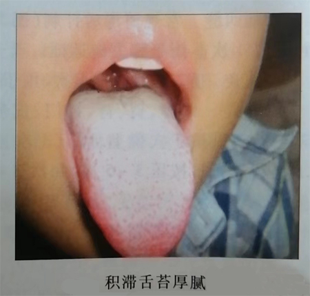 用于治疗小儿大便干燥、口臭、食欲不振、上火的中成药