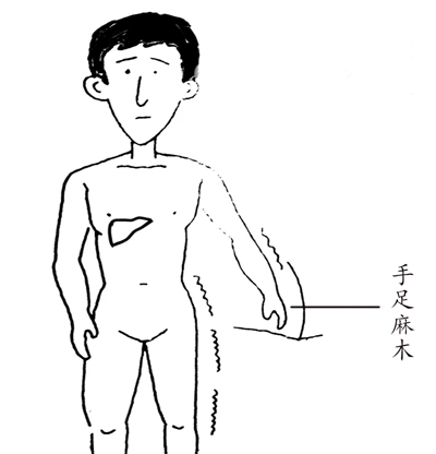 黄芪桂枝五物汤，治麻木第一方！