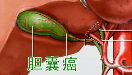中医治疗胆囊癌医案