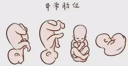 治疗胎位不正验案