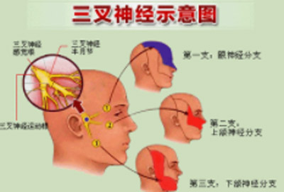 治三叉神经痛高效良方
