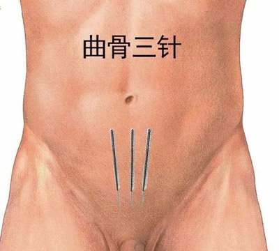 曲骨三针：治男性尿频，女性漏尿！