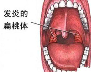 中医治扁桃体炎方