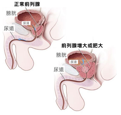 一个治好前列腺增生的老中医名方