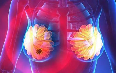 治疗乳腺结节的中成药