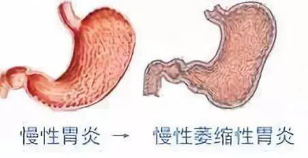 通、清、润、升四法并用，刘启泉治疗慢性萎缩性胃炎经验分享