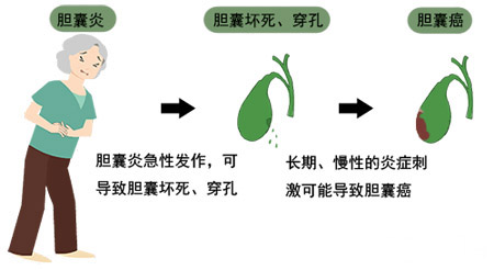 中医快速治愈胆囊炎方法