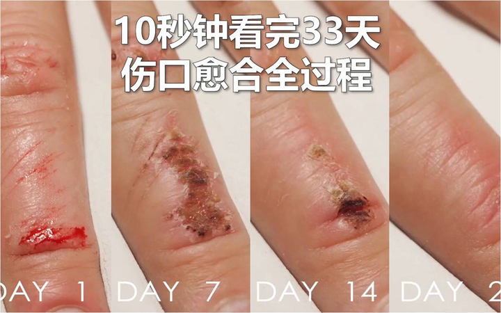 伤口自愈