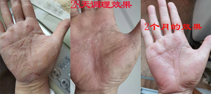 硬皮病