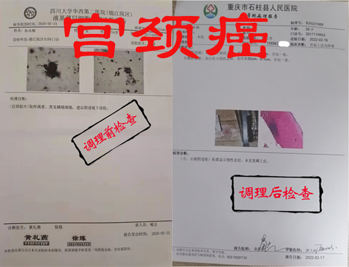 宫颈癌