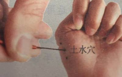 针刺土水穴治胃病