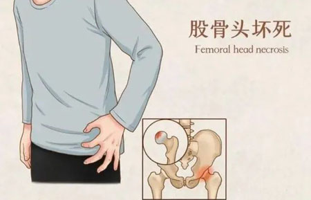 什么是股骨头坏死？