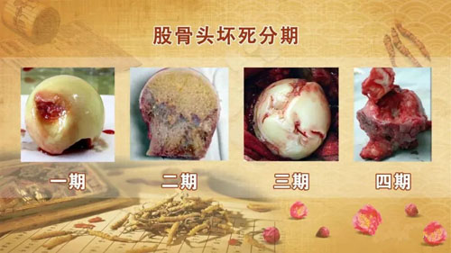 什么是股骨头坏死？