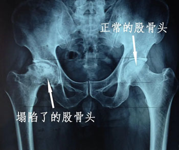 什么是股骨头坏死？
