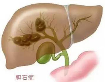 治疗慢性胆囊炎、胆石症特效方