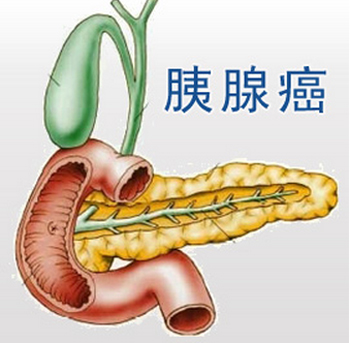 枳实消痞丸合失笑散治疗胰腺癌术后、放化疗后重度腹痛