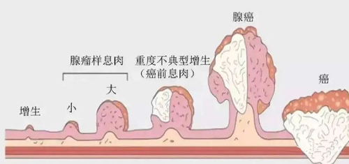 不手术去息肉的良方